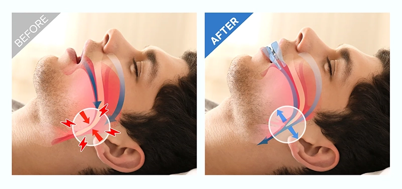 Anti Snoring Device